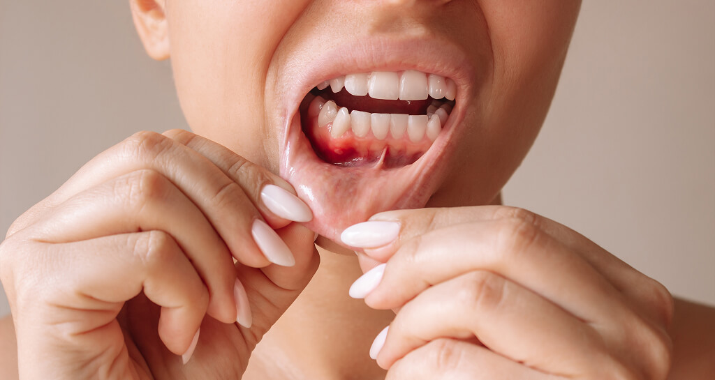 How Long Does It Take For Gum Grafting To Heal​?