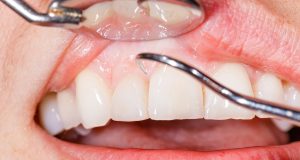 Is It Too Late for Gum Grafting? Understanding the Right Timing for Treatment